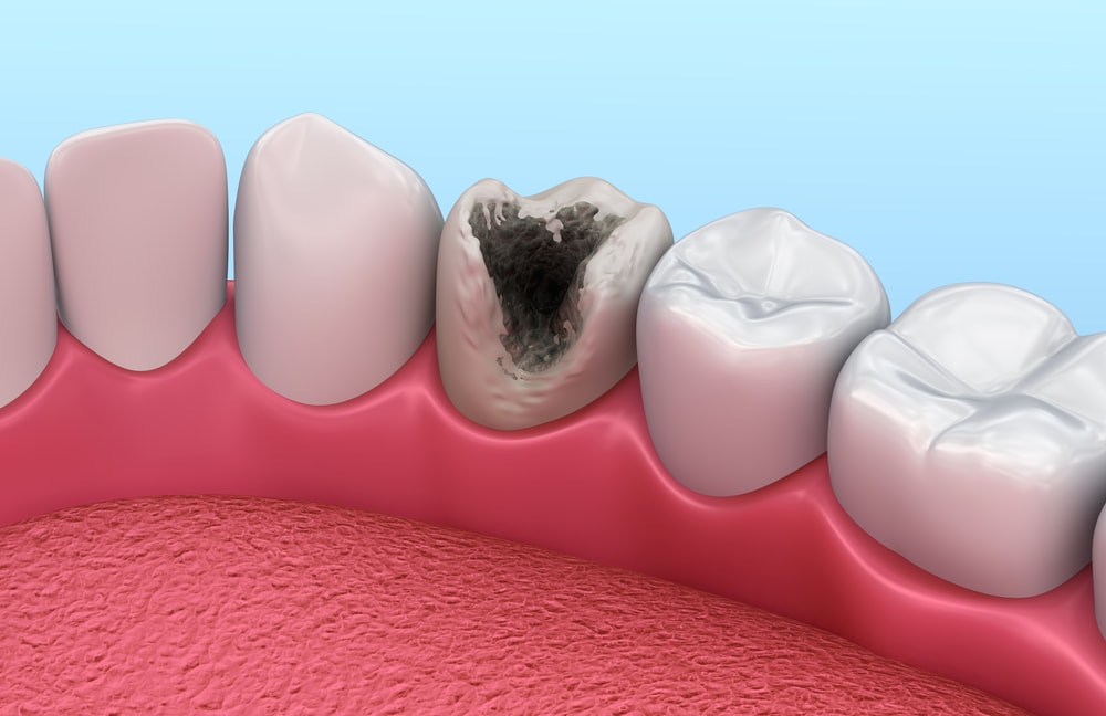 Восстановление сильно разрушенных зубов